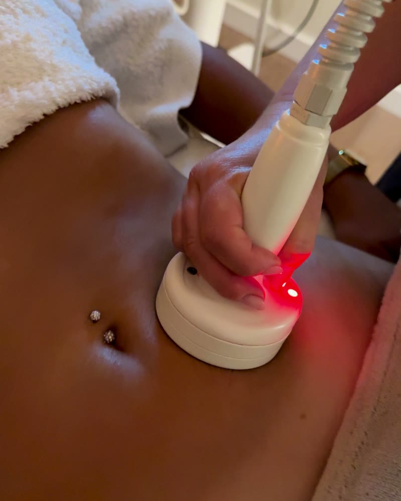 Radiofrecuencia corporal T-Dynamics sobre el abdomen
